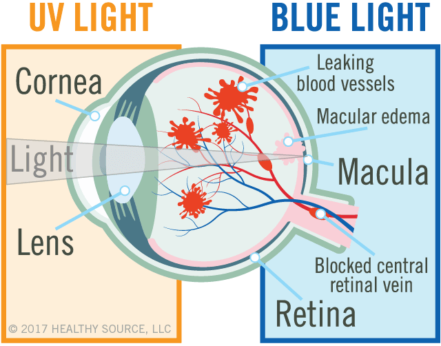 diagram of eye shows cornea, lens, macula and retina, leaking blood vessels, macular edema (swelling in macula), blocked central retinal vein.